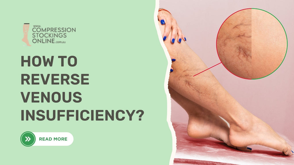 How to Reverse Venous Insufficiency With Proven Solutions