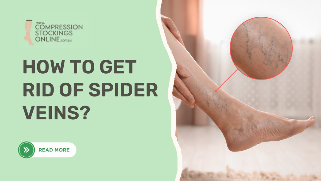 How to Get Rid of Spider Veins: Treatments, Compression and Prevention