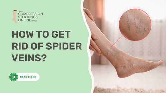 How to Get Rid of Spider Veins: Treatments, Compression and Prevention