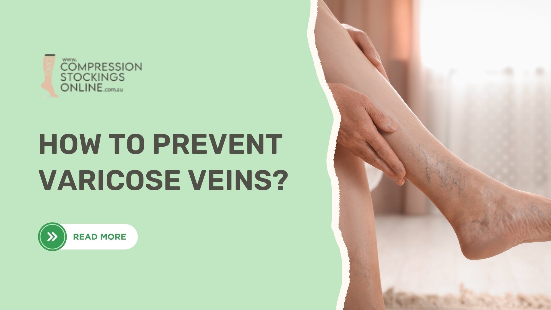 How to Prevent Varicose Veins: Tips and Treatments – Compression ...