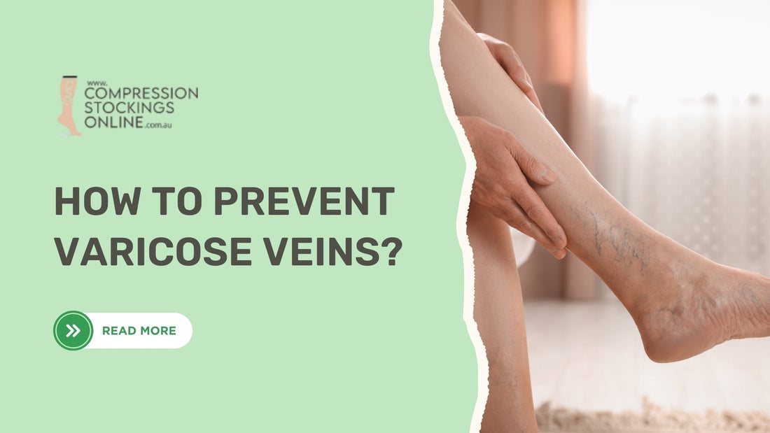 How to Prevent Varicose Veins?