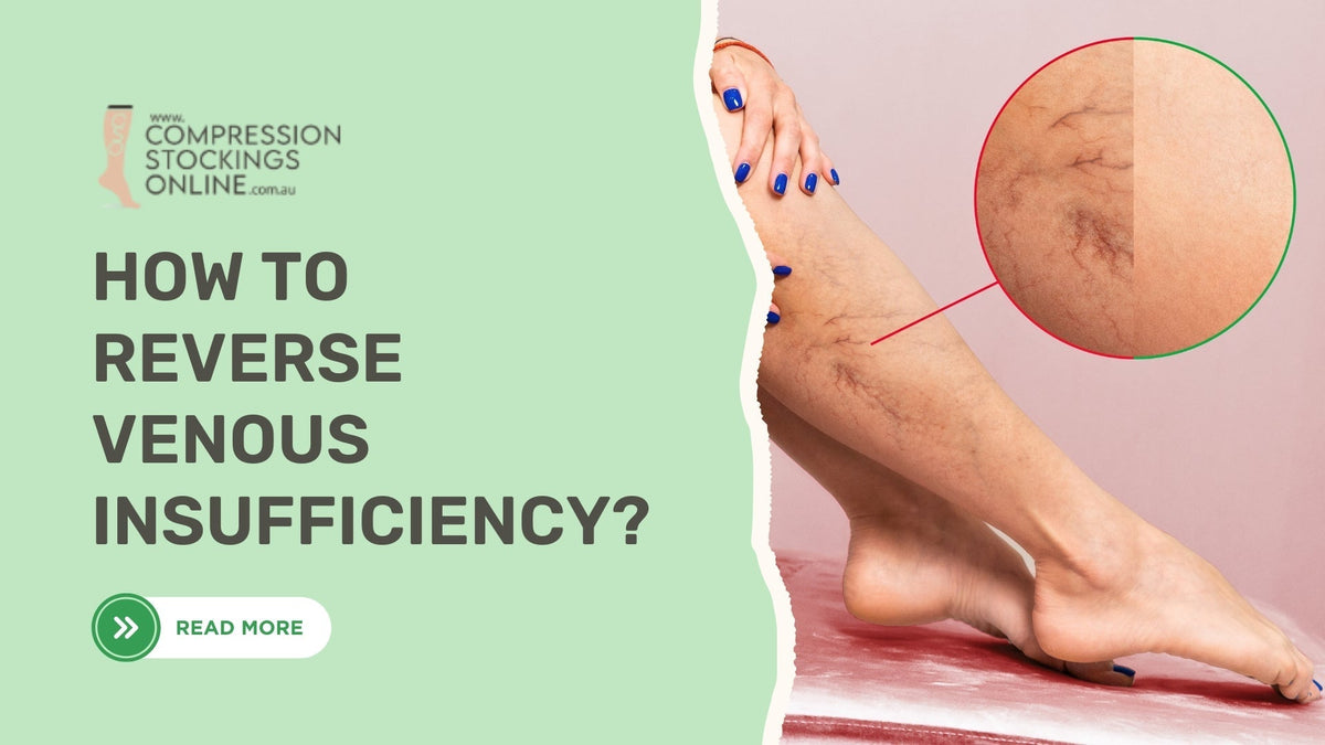 How to Reverse Venous Insufficiency With Proven Tips– Compression ...