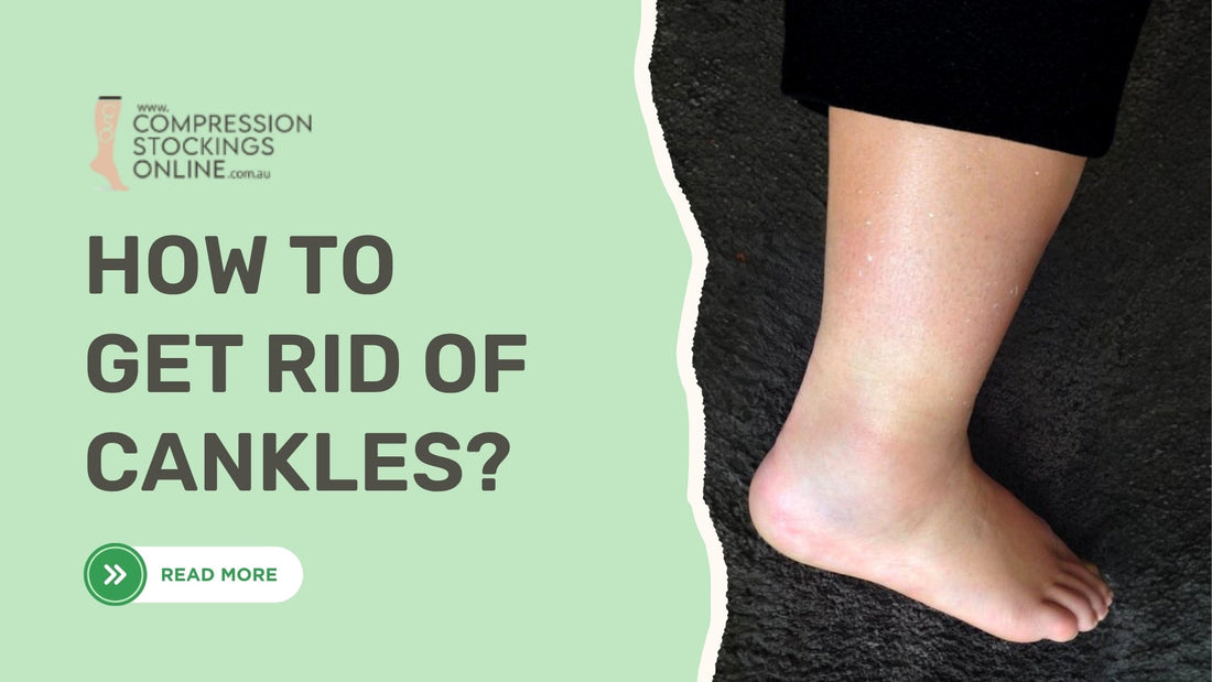 How to get rid of cankles
