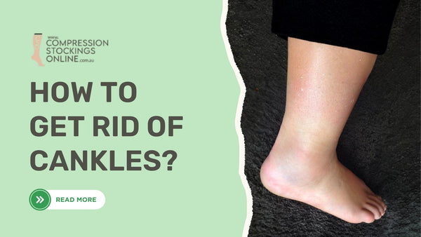 How to get rid of cankles